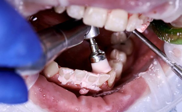 Quelle est l'importance des nettoyages dentaires réguliers proposés par le Centre dentaire GK ?